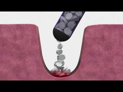 FDA approves device to stop bleeding from gunshot wounds in 15 seconds
