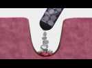 FDA approves device to stop bleeding from gunshot wounds in 15 seconds
