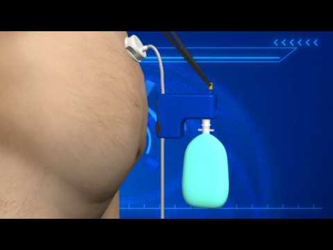 FDA approves ‘abdominal vomiting’ weight-loss device