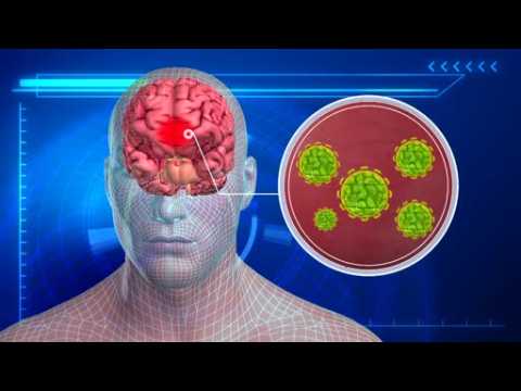 Zika virus may be linked to neurological disorders in adults
